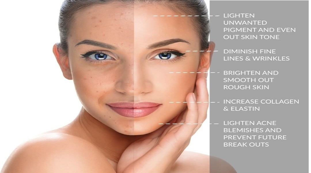 chemical peel