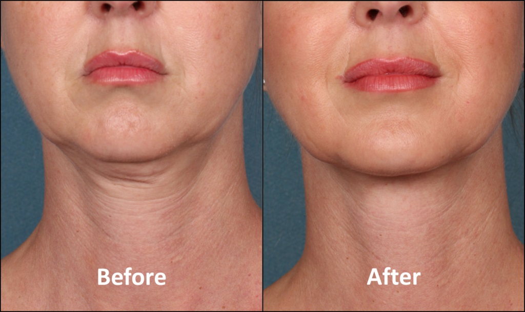 Neck Rejuvenation