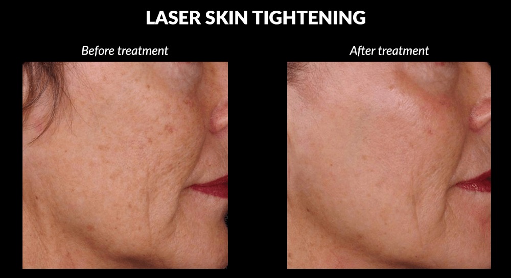 Skin Tightening