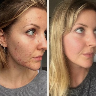 Acne & Scar Removal