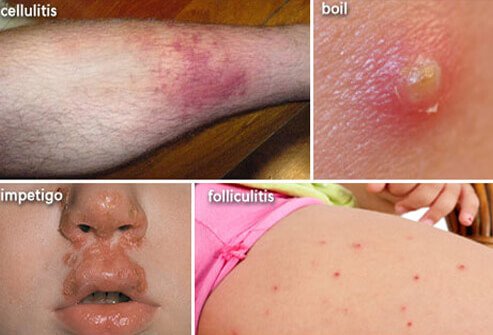 Bacterial Infection