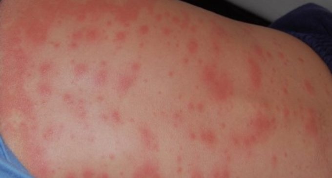 Viral Infection