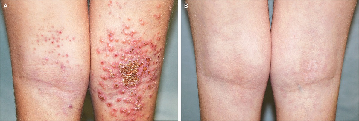 Eczema