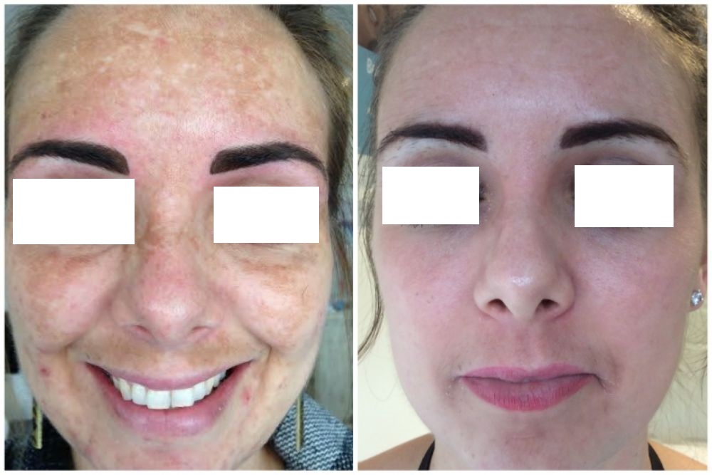 Melasma