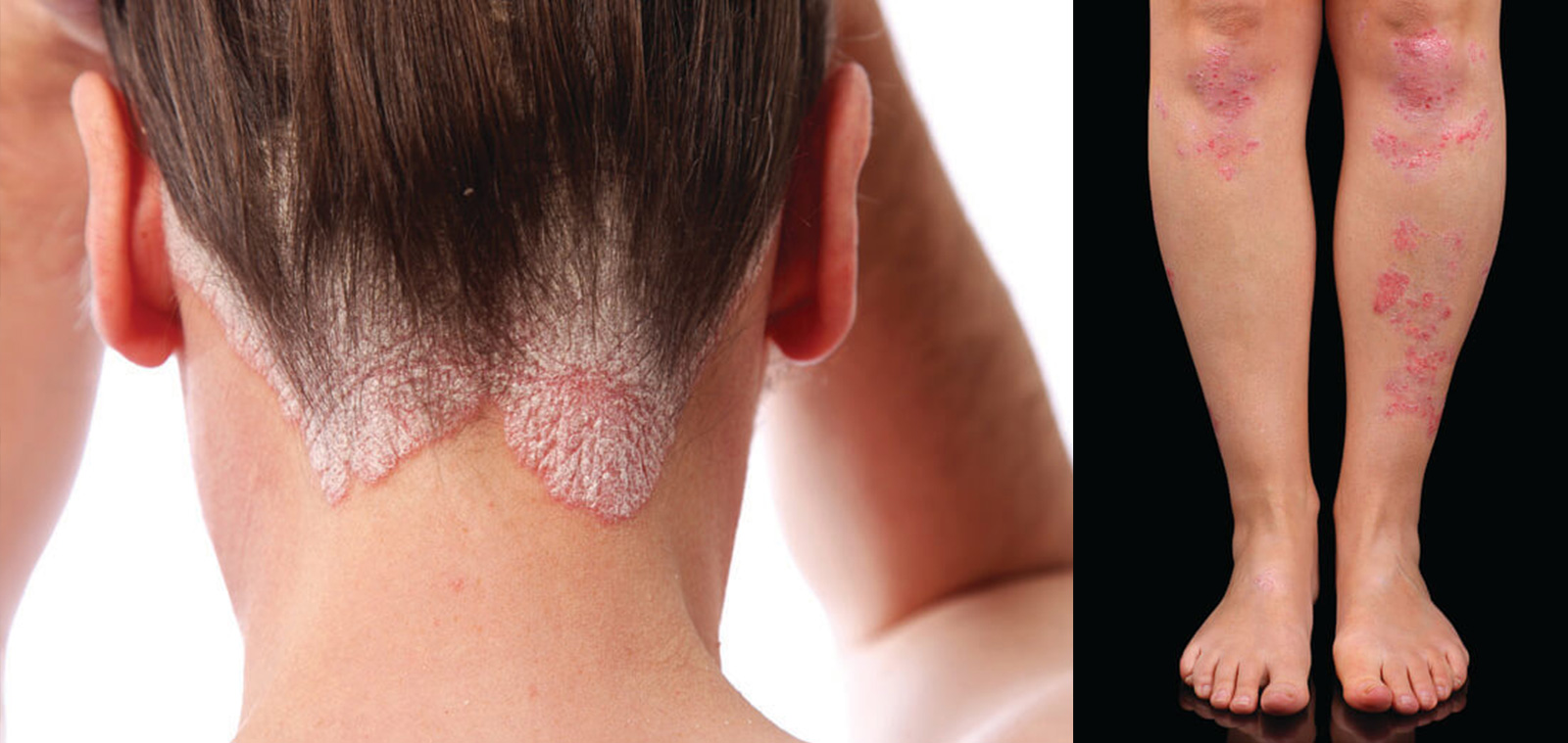 Psoriasis""