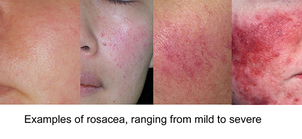 Rosacea