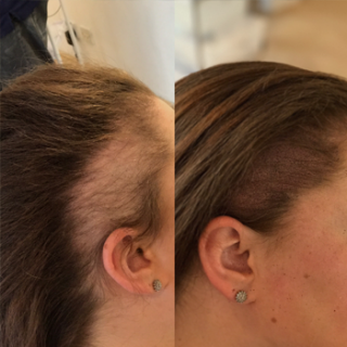 Hair Transplant
