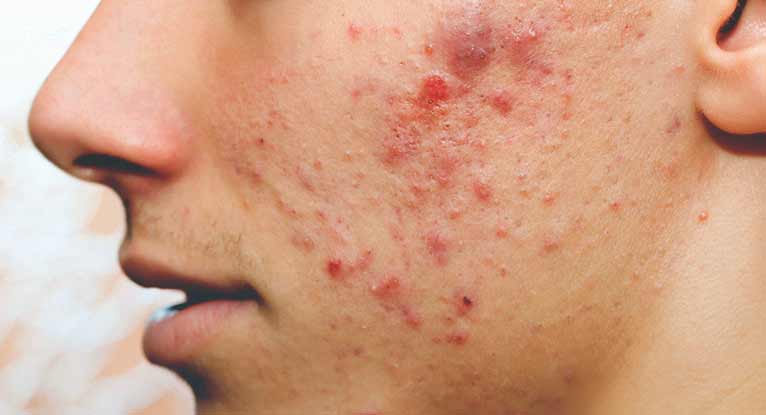 Acne and pimples