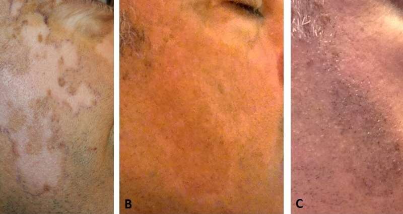 Pigmentation