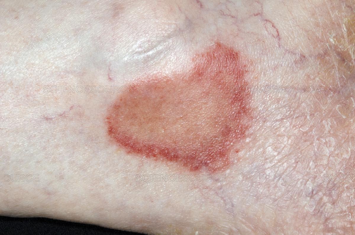 Ringworm