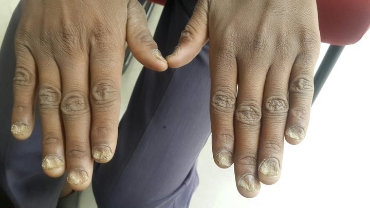 Manage Skin and nail condition