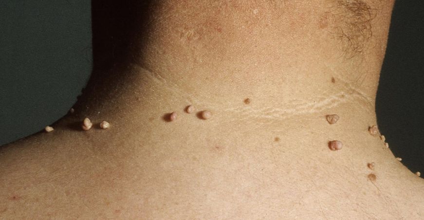 Skin Tag