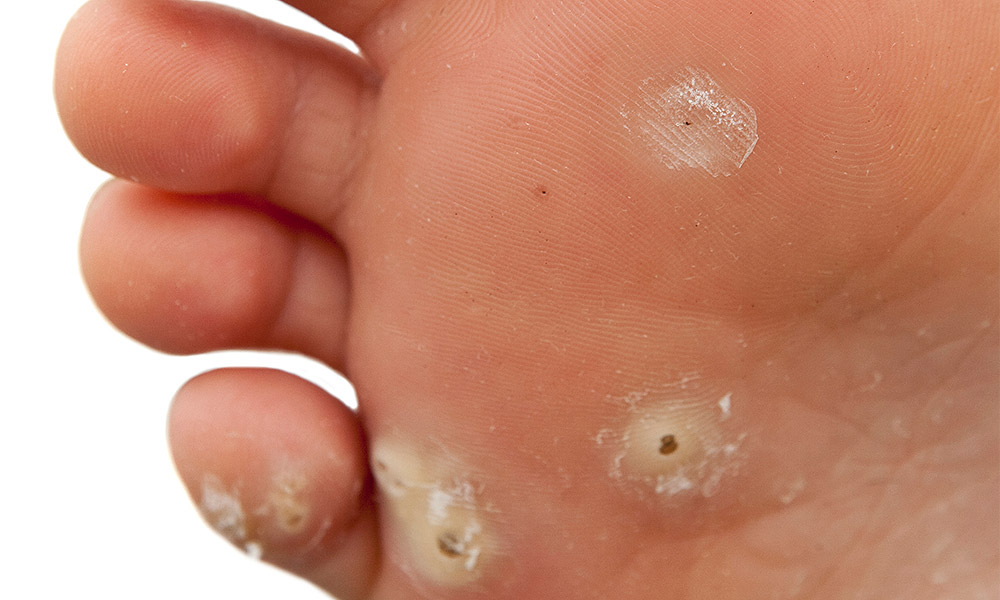 Warts